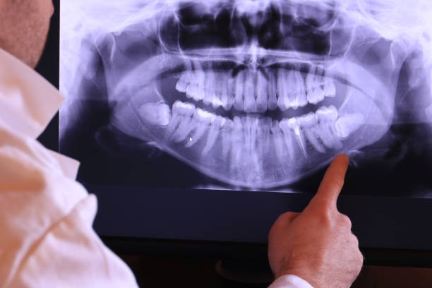 Best Emergency Dental Extractions in Carrington, ND